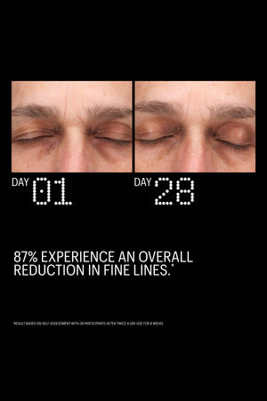 Before and after: reduced eye-area fine lines after 28 days